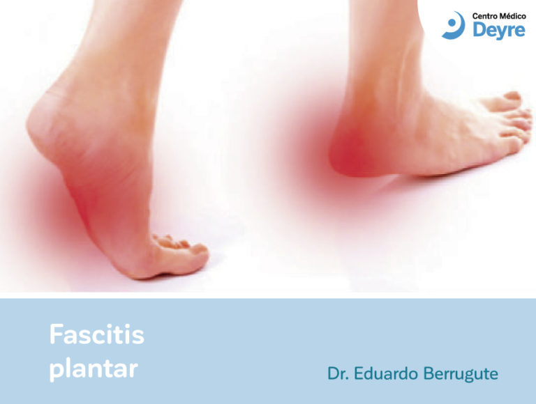 Fascitis plantar Centro Médico Deyre